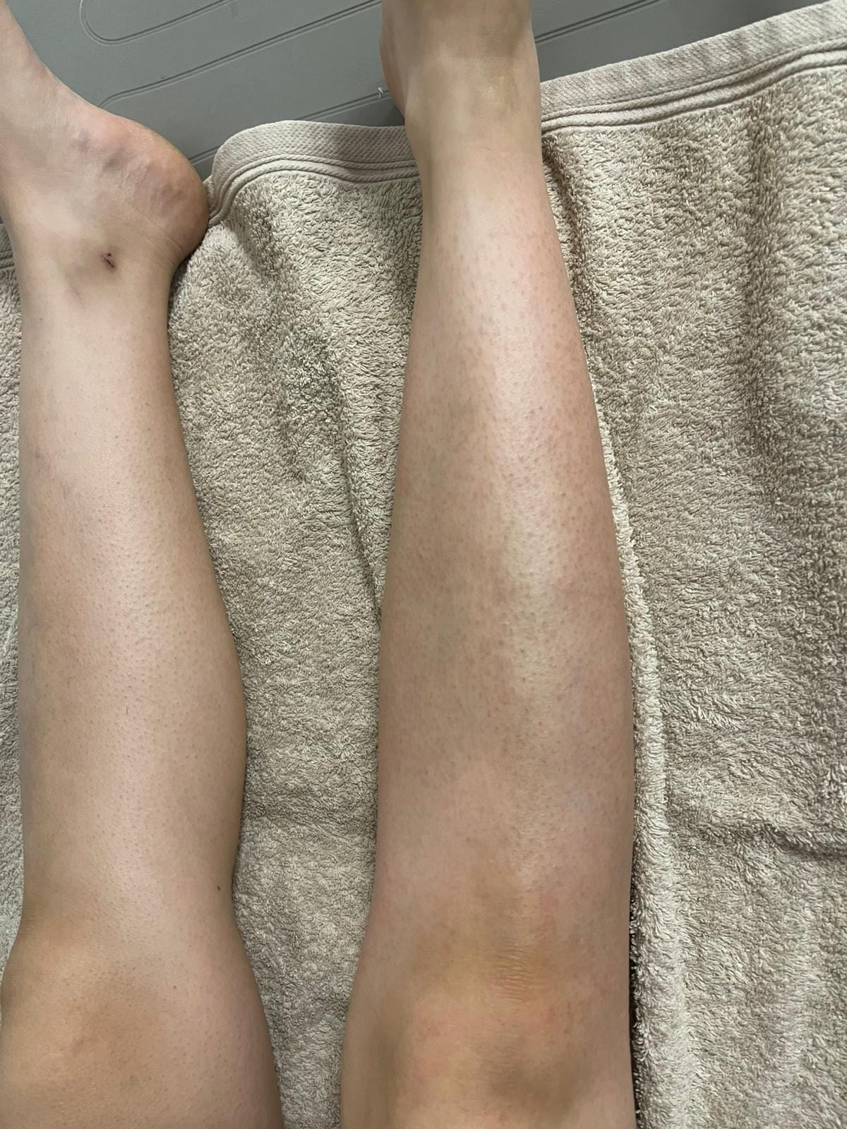  Entfernung von Pigmentflecken